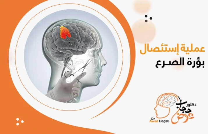 عملية استئصال بؤرة الصرع 